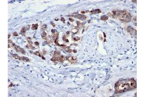 Formalin-fixed, paraffin-embedded human Gastric Carcinoma stained with CDC20 Mouse Monoclonal Antibody (AR12). (CDC20 抗体)