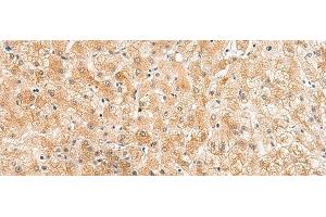 Immunohistochemistry of paraffin-embedded Human liver cancer tissue using ZNF185 Polyclonal Antibody at dilution of 1:25(x200) (Zinc Finger Protein 185 抗体)