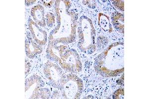 Immunohistochemical analysis of MKK1/2 (pS222/226) staining in human colon cancer formalin fixed paraffin embedded tissue section. (MEK1 抗体  (pSer222, pSer226))
