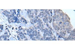 Immunohistochemistry of paraffin-embedded Human thyroid cancer tissue using TIA1 Polyclonal Antibody at dilution of 1:30(x200) (TIA1 抗体)