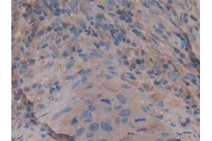 Detection of Rock2 in Human Lung cancer Tissue using Polyclonal Antibody to Rho Associated Coiled Coil Containing Protein Kinase 2 (Rock2) (ROCK2 抗体  (AA 904-1140))