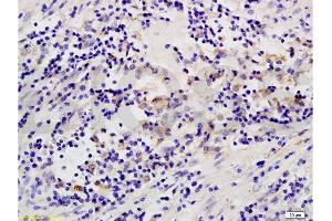 Formalin-fixed and paraffin embedded human colon carcinoma labeled with Anti-MAP3K8/TPL2 Polyclonal Antibody, Unconjugated  at 1:200 followed by conjugation to the secondary antibody and DAB staining.