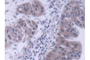 DAB staining on IHC-P; Samples: Human Liver cancer Tissue (DP1 抗体  (AA 6-410))