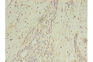 Immunohistochemistry of paraffin-embedded human breast cancer using ABIN7159252 at dilution of 1:100 (MAGEA1 抗体  (AA 2-225))