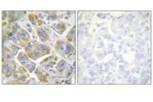 Immunohistochemistry analysis of paraffin-embedded human breast carcinoma tissue using ITGB4 (Ab-1510) antibody. (Integrin beta 4 抗体  (Tyr1510))