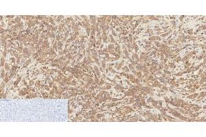Immunohistochemistry of paraffin-embedded Human breast cancer tissue using Phospho-Catenin beta (Ser37) Polyclonal Antibody at dilution of 1:200 (beta Catenin 抗体  (pSer37))
