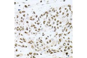 Immunohistochemistry of paraffin-embedded human lung cancer using BCCIP antibody (ABIN5995871) at dilution of 1/100 (40x lens). (BCCIP 抗体)