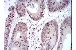 Immunohistochemical analysis of paraffin-embedded colon cancer tissues using HOXB4 mouse mAb with DAB staining. (HOXB4 抗体  (AA 16-251))