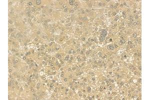 ABIN6262303 and ABIN6276781 at 1/100 staining human hepatocellular carcinoma by IHC-P. (HMGCR 抗体  (N-Term))