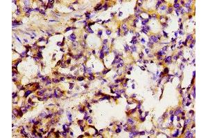 Immunohistochemistry of paraffin-embedded human gastric cancer using ABIN7170131 at dilution of 1:100 (SLC22A1 抗体  (AA 43-149))