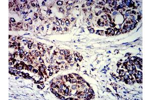 Immunohistochemical analysis of paraffin-embedded ovarian cancer tissues using PIGR mouse mAb with DAB staining. (PIGR 抗体  (AA 19-170))