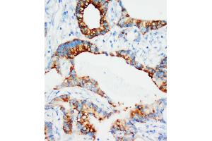 Anti-IGFBP3 antibody, IHC(P) IHC(P): Human Mammary Cancer Tissue (IGFBP3 抗体  (Middle Region))