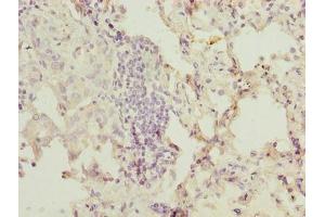 Immunohistochemistry of paraffin-embedded human lung cancer using ABIN7174654 at dilution of 1:100 (OGT 抗体  (AA 606-1022))