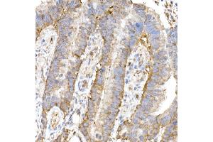 Immunohistochemistry of paraffin-embedded human colon carcinoma using MK4 Rabbit mAb (ABIN7268653) at dilution of 1:50 (40x lens). (MAP3K4 抗体)