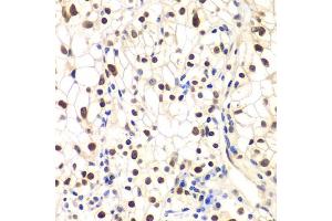 Immunohistochemistry of paraffin-embedded human kidney cancer using NFKBIB antibody (ABIN6130475, ABIN6144584, ABIN6144585 and ABIN6221459) at dilution of 1:200 (40x lens). (NFKBIB 抗体  (AA 1-356))