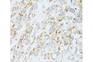 Immunohistochemistry of paraffin-embedded Human lung cancer using EGFR Polyclonal Antibody at dilution of 1:100 (40x lens).