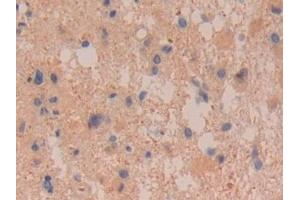 Detection of DDAH2 in Human Glioma Tissue using Polyclonal Antibody to Dimethylarginine Dimethylaminohydrolase 2 (DDAH2) (DDAH2 抗体  (AA 31-265))