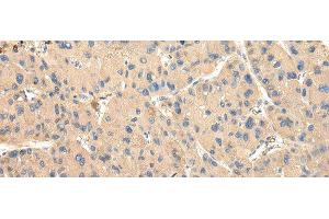 Immunohistochemistry of paraffin-embedded Human liver cancer tissue using DUSP11 Polyclonal Antibody at dilution 1:50 (DUSP11 抗体)