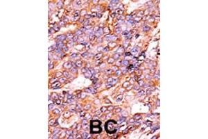 Immunohistochemistry (Formalin/PFA-fixed paraffin-embedded sections) of human breast carcinoma with Histone H3 (phospho S10) polyclonal antibody , followed by peroxidase-conjugated secondary antibody and AEC staining. (Histone H3.3 抗体  (pSer10))