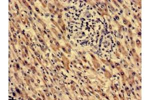 Immunohistochemistry analysis of human liver cancer using ABIN7172382 at dilution of 1:100 (MECR 抗体  (AA 211-373))