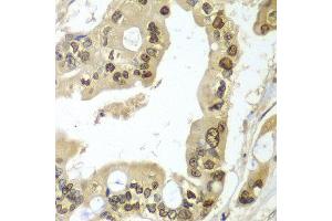 Immunohistochemistry of paraffin-embedded human liver cancer using UBE2B antibody at dilution of 1:100 (x40 lens). (UBE2B 抗体)
