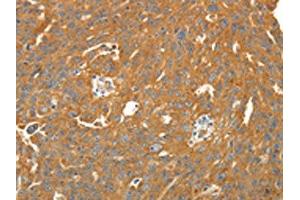 The image on the left is immunohistochemistry of paraffin-embedded Human ovarian cancer tissue using ABIN7131067(SIRT4 Antibody) at dilution 1/25. (SIRT4 抗体)