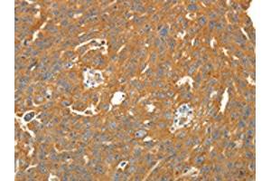 The image on the left is immunohistochemistry of paraffin-embedded Human ovarian cancer tissue using ABIN7131067(SIRT4 Antibody) at dilution 1/25.