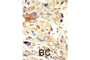 Formalin-fixed and paraffin-embedded human cancer tissue reacted with the primary antibody, which was peroxidase-conjugated to the secondary antibody, followed by AEC staining. (EGFR 抗体  (N-Term))