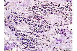 Formalin-fixed and paraffin embedded human colon carcinoma labeled with Anti CCR7/CD197 Polyclonal Antibody, Unconjugated (ABIN674724) at 1:200 followed by conjugation to the secondary antibody and DAB staining (CCR7 抗体  (AA 25-59))