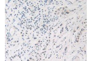 IHC-P analysis of Human Stomach Cancer Tissue, with DAB staining. (FDFT1 抗体  (AA 269-417))