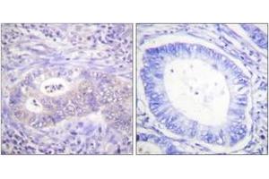 Immunohistochemistry analysis of paraffin-embedded human colon carcinoma, using PFKFB2 (Phospho-Ser483) Antibody. (PFKFB2 抗体  (pSer483))