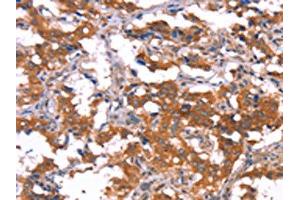 The image on the left is immunohistochemistry of paraffin-embedded Human thyroid cancer tissue using ABIN7190910(HCAR2 Antibody) at dilution 1/40, on the right is treated with synthetic peptide. (HCAR2 抗体)