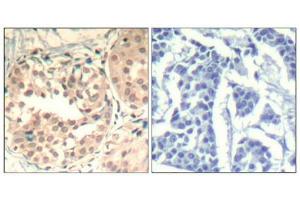 Immunohistochemical analysis of paraffin-embedded human breast carcinoma tissue using CDK6(Phospho-Tyr13) Antibody(left) or the same antibody preincubated with blocking peptide(right). (CDK6 抗体  (pTyr13))