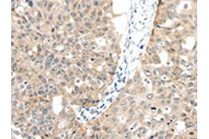 The image on the left is immunohistochemistry of paraffin-embedded Human ovarian cancer tissue using ABIN7130157(MAP3K14 Antibody) at dilution 1/30, on the right is treated with fusion protein. (MAP3K14 抗体)