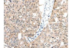 The image on the left is immunohistochemistry of paraffin-embedded Human ovarian cancer tissue using ABIN7130157(MAP3K14 Antibody) at dilution 1/30, on the right is treated with fusion protein.