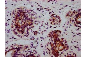 IHC image of ABIN7127690 diluted at 1:100 and staining in paraffin-embedded human breast cancer performed on a Leica BondTM system. (Recombinant EIF2S1 抗体  (pSer51))