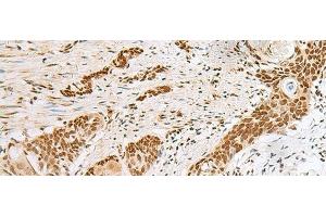 Immunohistochemistry of paraffin-embedded Human esophagus cancer tissue using PNRC2 Polyclonal Antibody at dilution of 1:30(x200) (PNRC2 抗体)