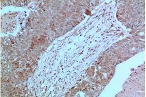 Immunohistochemistry of paraffin-embedded Human breast carcinoma tissue using JAK2 Monoclonal Antibody at dilution of 1:200. (JAK2 抗体)