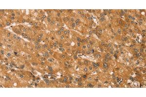 Immunohistochemistry of paraffin-embedded Human liver cancer tissue using SNAP29 Polyclonal Antibody at dilution 1:45 (SNAP29 抗体)