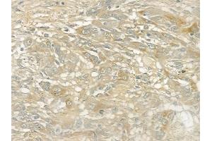ABIN6260440 and ABIN6272875 at 1/100 staining human tongue carcinoma by IHC-P. (CAMSAP2 抗体  (C-Term))