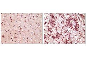 Immunohistochemical analysis of paraffin-embedded human brain tumor tissue, showing nuclear and cytoplasmic localization using ELK1 mouse mAb with DAB staining.