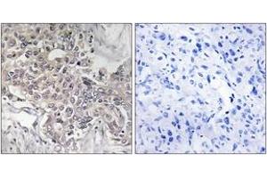Immunohistochemistry analysis of paraffin-embedded human liver carcinoma tissue, using Cytochrome P450 4Z1 Antibody. (CYP4Z1 抗体  (AA 71-120))