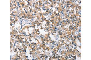 Immunohistochemistry of Human gastric cancer using SCARB1 Polyclonal Antibody at dilution of 1:65 (SCARB1 抗体)
