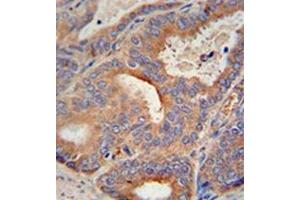 Immunohistochemistry analysis in formalin fixed and paraffin embedded human prostate carcinoma reacted with GLB1L2 Antibody (C-term) followed by peroxidase conjugation of the secondary antibody and DAB staining.