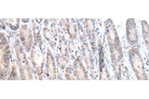 Immunohistochemistry of paraffin-embedded Human gastric cancer tissue using CALB2 Polyclonal Antibody at dilution of 1:25(x200) (Calretinin 抗体)