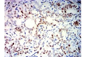 Immunohistochemical analysis of paraffin-embedded cervical cancer tissues using PGR mouse mAb with DAB staining. (Progesterone Receptor 抗体  (AA 166-411))