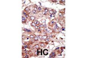Formalin-fixed and paraffin-embedded human hepatocellular carcinoma tissue reacted with the ACSL6 polyclonal antibody  , which was peroxidase-conjugated to the secondary antibody, followed by AEC staining. (ACSL6 抗体  (Internal Region))