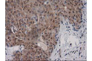 Immunohistochemical staining of paraffin-embedded Adenocarcinoma of Human breast tissue using anti-DSTN mouse monoclonal antibody. (Destrin 抗体)