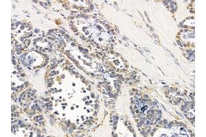 ABIN6258026 and ABIN6275228 at 1/100 staining human ovarian cancer by IHC-P. (CLNS1A 抗体  (C-Term))