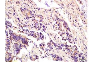 Formalin-fixed and paraffin embedded human colon carcinoma labeled with Anti-ompF(putative outer membrane porin F protein) Polyclonal Antibody, Unconjugated  at 1:200 followed by conjugation to the secondary antibody and DAB staining. (Ompf (AA 171-213) 抗体)